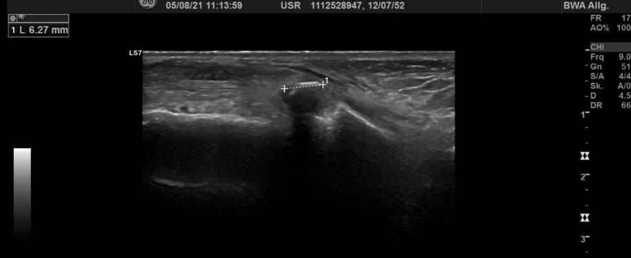 Fussrücken, kaudoventral des Malleolus lateralis Fussrücken, kaudoventral des Malleolus lateralis
