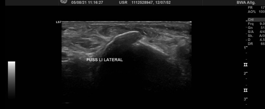 Fussrücken, kaudoventral des Malleolus lateralis Fussrücken, kaudoventral des Malleolus lateralis