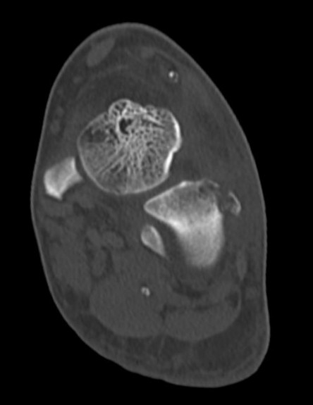 Fussrücken, kaudoventral des Malleolus lateralis Fussrücken, kaudoventral des Malleolus lateralis