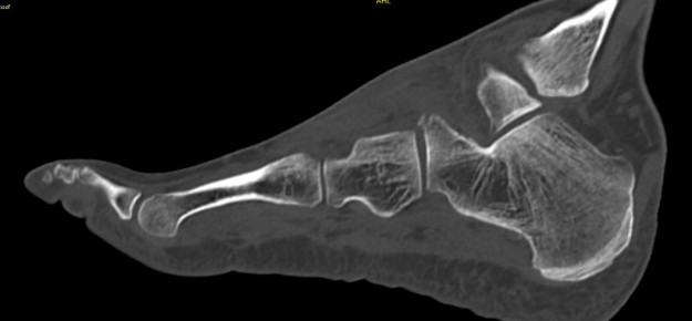 Fussrücken, kaudoventral des Malleolus lateralis Fussrücken, kaudoventral des Malleolus lateralis